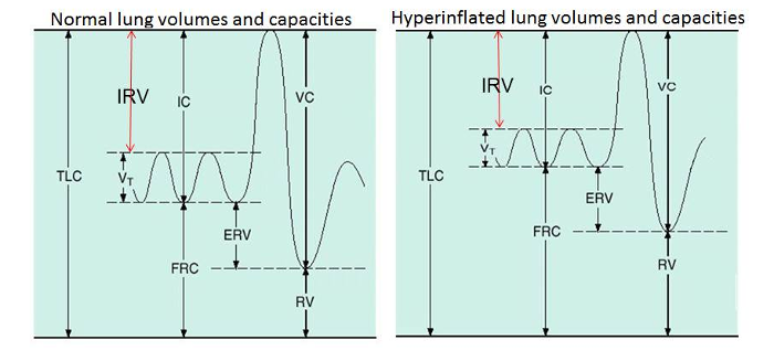 Lung hyperinflation graphs