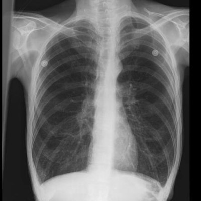 Chest X-ray