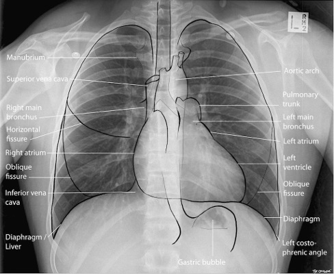 Chest X-ray, labelled