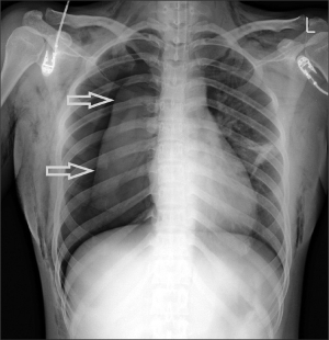 chest x-ray showing pneumothorax & subcutaneous emphysema 