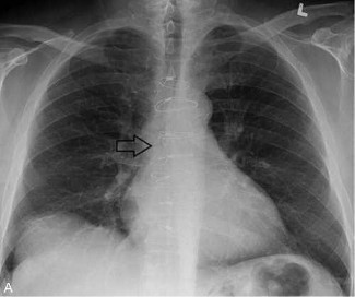 Chest X-ray image for Sanjit Patel case study
