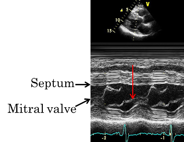 Echocardiogram image annotated - normal cycle