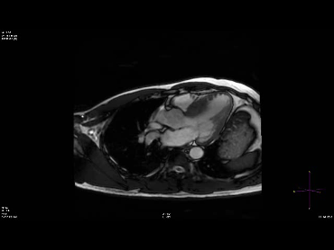 Cardiac-MRI image (ASH)