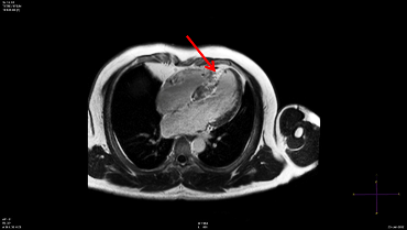 Cardiac-MRI image (fibrosis)
