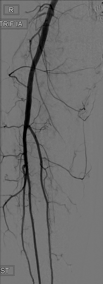 angiogram 3