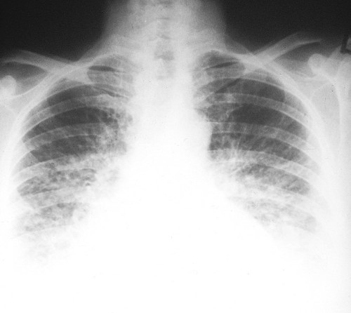 Chest X-ray 
