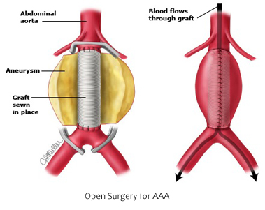Open surgery for AAA 