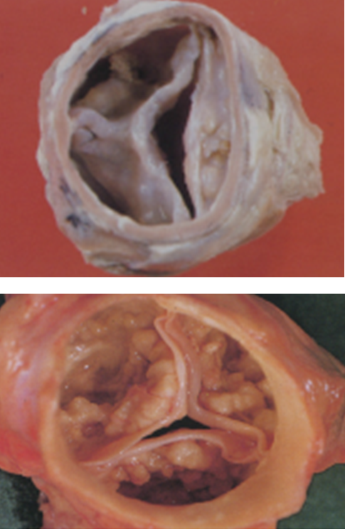 Images showing aortic stenosis variants