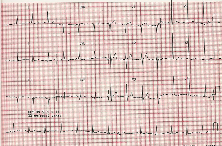 12 lead ECG