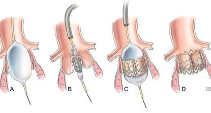 European Society of Cardiology guidelines on the management of patients with severe symptomatic aortic stenosis