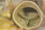 aortic valve images