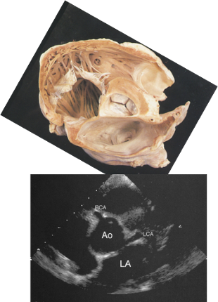 aortic valve images