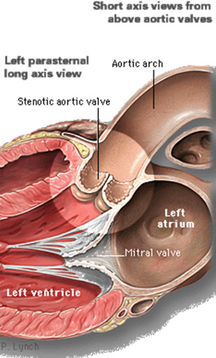 aortic valve images