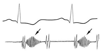 phonocardiogram output