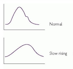 Graphs: normal and slow-rising pulse dynamics