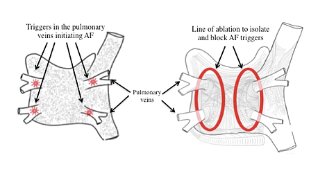 Catheter Ablation