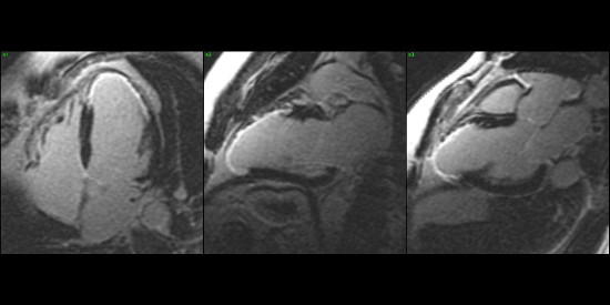 Cardiac MRI